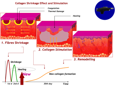 Skin resurfacing